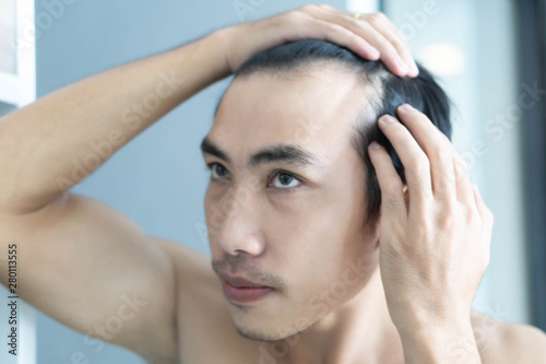 Young man serious hair loss problem for health care medical and shampoo product concept, selective focus