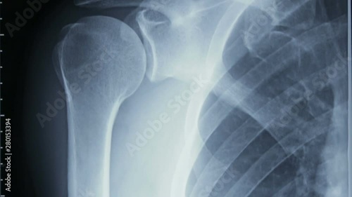Vertical tracking shot of an x-ray of human shoulder bones, front view.