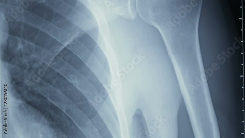 Vertical tracking shot of an x-ray of human shoulder bones, front view.