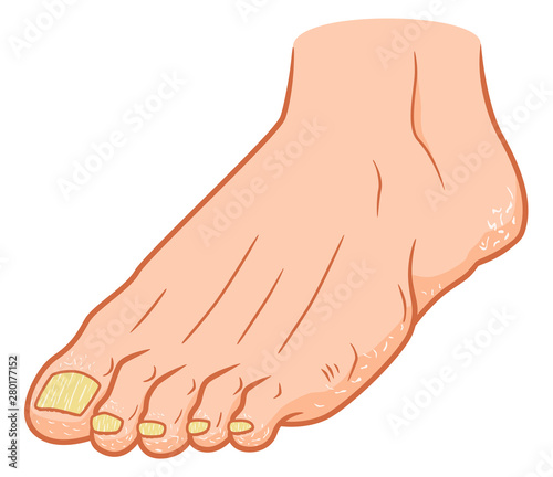 Foot with nail fungus