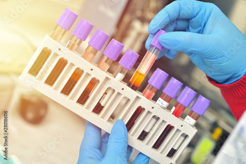 Tubes of blood sample for testing. Medical equipment