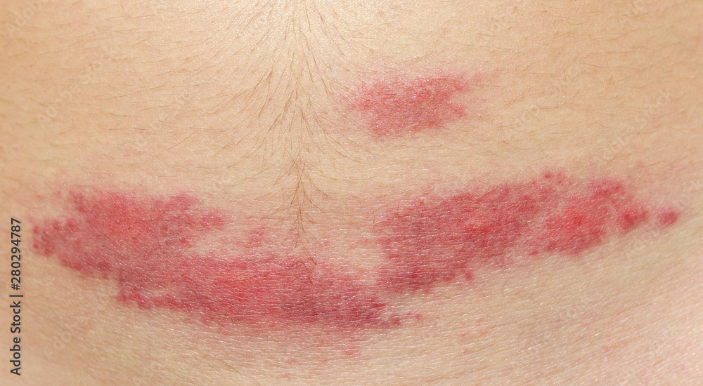 Fototapeta premium midge mosquito bite. reaction to the bite of midges. allergy. danger of insect bites in the summer. red spot at the bite site after a day