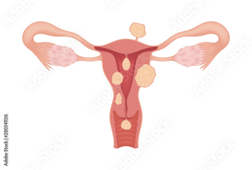 Sick female reproductive system with various types of myomas isolated on whte background. Realistic drawing showing the internal organs. Frontal view in a cut.