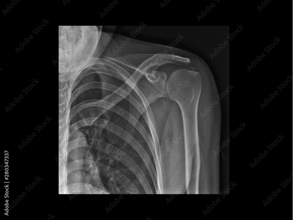 Film Xray shoulder radiograph showing calcium deposit on supraspinatus of rotator cuff tendon