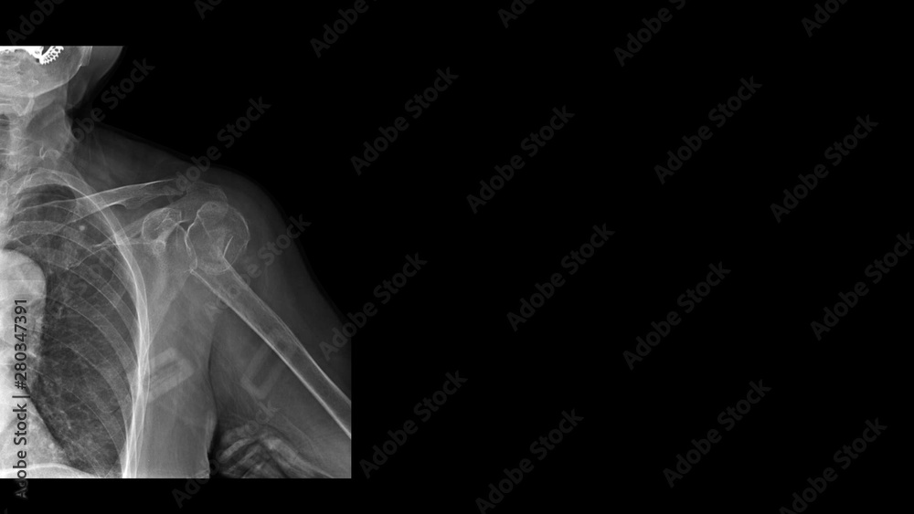 Film xray shoulder radiograph show shoulder dislocation and bone