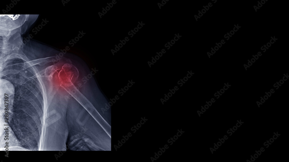 Film X ray shoulder radiograph show shoulder dislocation and bone