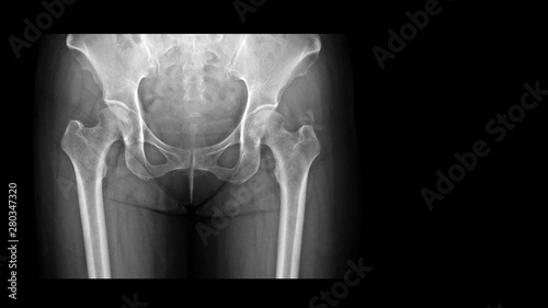 Film X-ray hip radiograph showing calcium deposit on abductor tendon of right hip (calcific tendinitis or tendinosis calcarea). This calcified tendon cause hip pain and swelling. photo