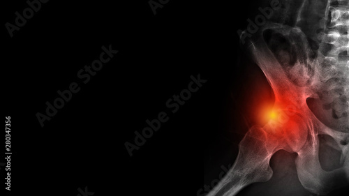 Film X-ray hip show FemoroAcetabular Impingement disease(FAI) or Hip impingement syndrome. FAI cause from abnormal anatomy of hip joint (acetabulum and femur bone). Free copy space for medical poster