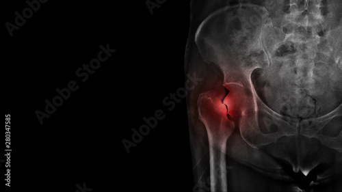 Photo Film X ray hip radiograph show broken hip bone ( neck of femur fracture )