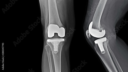 Film X-ray knee radiograph showing degenerative osteoarthritis (OA knee disorder) treated by total knee replacement surgery ( TKR ) or joint prosthesis and free copy space. Medical technology concept.