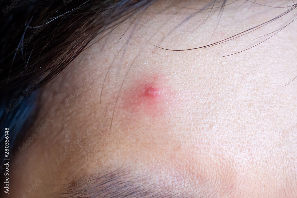 Inflammatory acne with red spot on face closeup Inflammatory acne with red spot on face closeup
