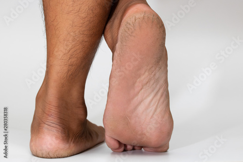 cracked heel dry skin foot skin on white background