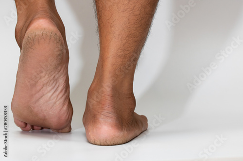 фотографія cracked heel dry skin foot skin on white background