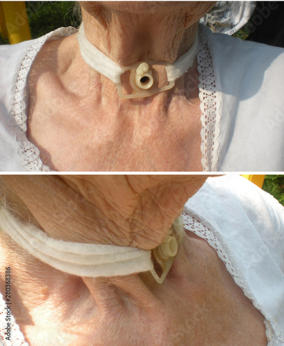 tracheostomy of an old woman after thyroid surgery. Tracheostomy tube photo