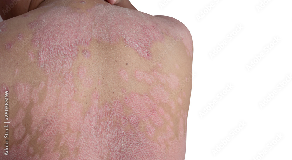 Fototapeta premium Close up the shoulder ulcers and back