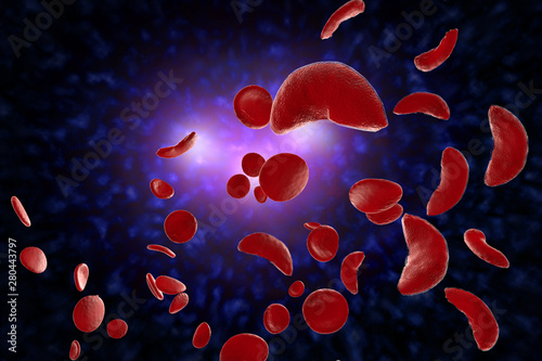 Sickle Cell Anemia 3D Illustration