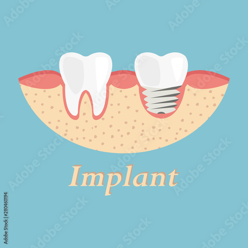 Teeth procedure of implant restoration. Process stomatology prosthesis