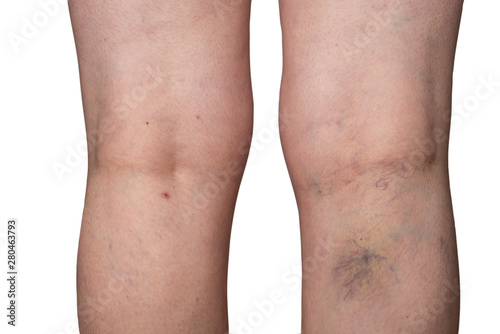 Bursted capillaries on a woman leg photo