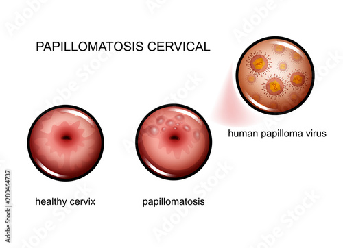 cervical papillomatosis. human papilloma virus photo