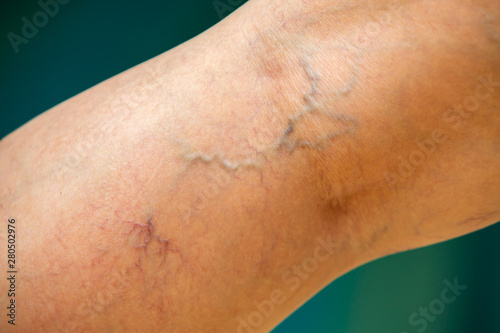 Varicose veins on the back of knee and leg in woman, Blue swimming pool background, Close up and macro shot, Selective focus, Asian Body skin part, Healthcare and Beauty concept