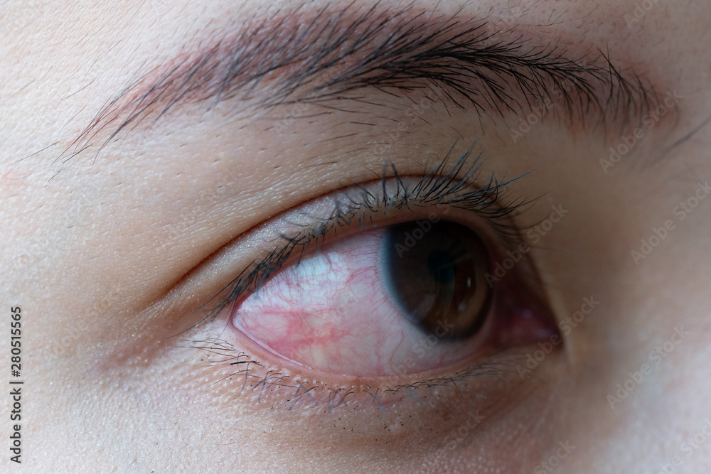 Red eye of woman , conjunctivitis eye or after cry Red eye of woman , conjunctivitis eye or after cry