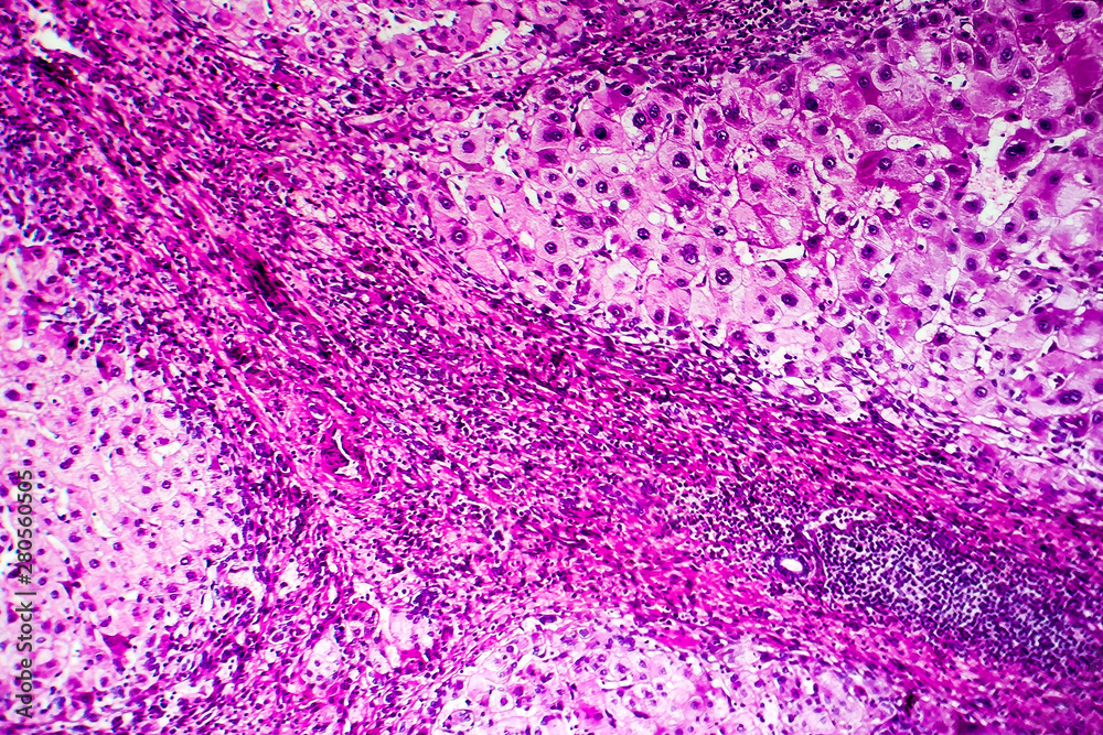 Histopathology of portal liver cirrhosis, light micrograph, photo under  microscope Stock Illustration | Adobe Stock