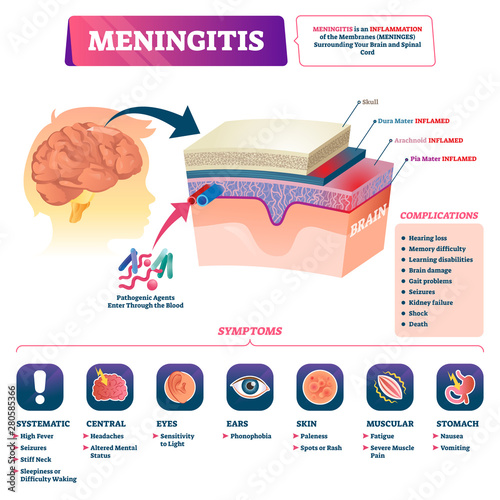 Meningitis vector illustration. Labeled brain membrane inflammation scheme. photo