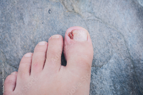 Foot with Infected ingrown toe nail on a grey background. Medical, treatment, health and medicine concept.