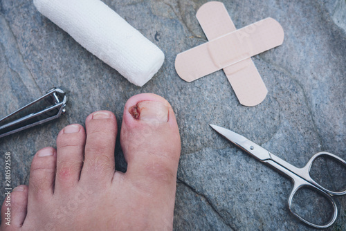 Photos Infected ingrown toe nail together with plaster, nail clipper, scissors and band aid laying on a grey background