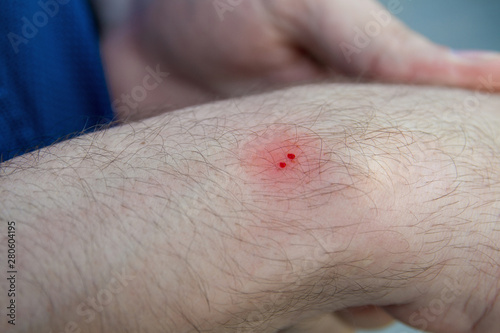 Male hand with the wound from snake bite (snakebite). Bite marks with blood drops and red skin. Closeup, selective focus photo