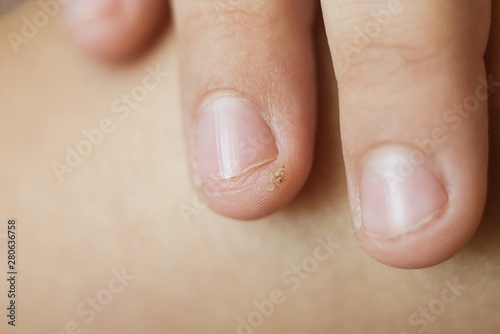 wart, papilloma on a childs finger. Macro shot, selective focus, close-up, space for text. Dermatological problems with the skin