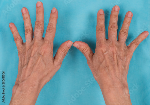 Φωτογραφία Inicial change in rheumatoid arthritis.  Ulnar deviation