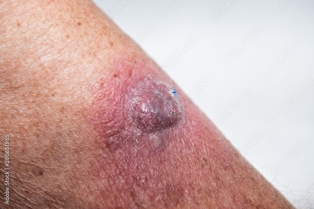 Fototapeta premium Squamous skin cell cancer