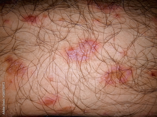 Pityriasis rosea on skin closeup. Fungal infections that cause rashes, dermatophytes, eczema, ringworm. Healthcare concept. Selective focus photo