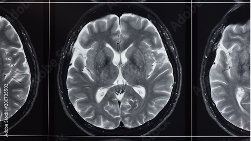 Photograph of T2 weighted magnetic resonance imaging of normal brain photo