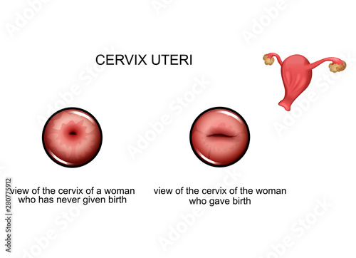 cervix before and after childbirth photo
