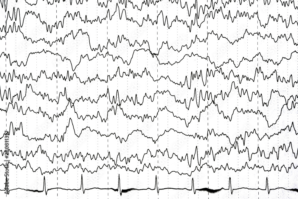 Brain wave patterns on electroencephalogram, EEG of the pediatric patients, problems in the electrical activity of the brain. Brain wave patterns on electroencephalogram, EEG of the pediatric patients, problems in the electrical activity of the brain.