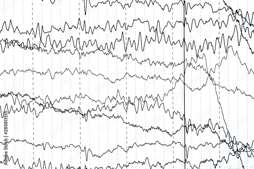 Brain wave patterns on electroencephalogram, EEG of the pediatric patients, problems in the electrical activity of the brain. Brain wave patterns on electroencephalogram, EEG of the pediatric patients, problems in the electrical activity of the brain.