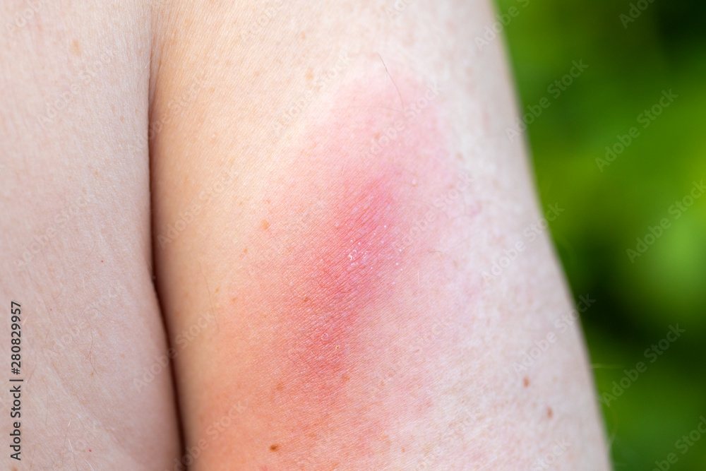 Fototapeta premium Lyme disease