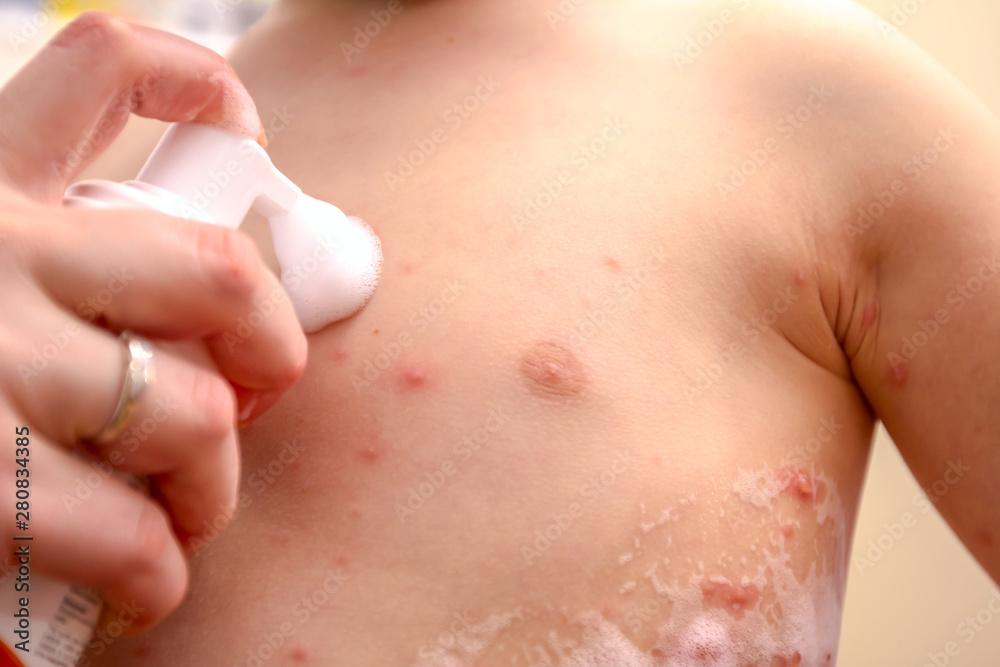 Therapy against the virus of Varicella has measles, chicken pox, rubella Therapy against the virus of Varicella has measles, chicken pox, rubella