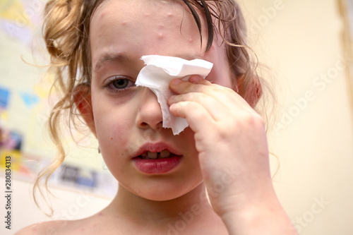 Fotografie Portrait of child has skin infected with chickenpox