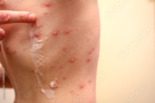 Obraz na plátně Therapy against the virus of Varicella has measles, chicken pox, rubella