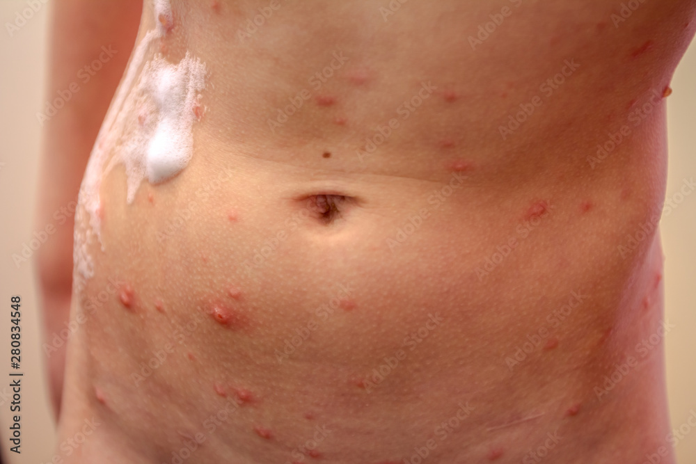 Therapy against the virus of Varicella has measles, chicken pox, rubella Therapy against the virus of Varicella has measles, chicken pox, rubella