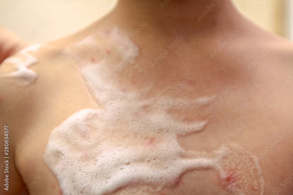 Therapy against the virus of Varicella has measles, chicken pox, rubella Therapy against the virus of Varicella has measles, chicken pox, rubella