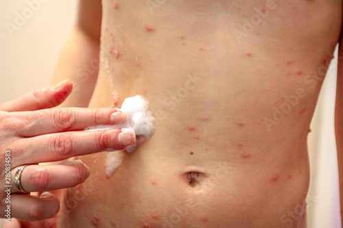 Therapy against the virus of Varicella has measles  chicken pox  rubella