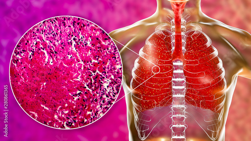 Miliary tuberculosis, illustration and light micrograph photo