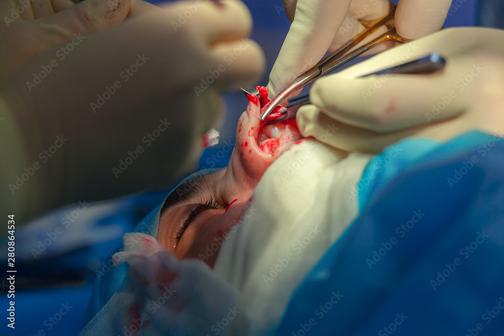 Surgeon and his assistant performing cosmetic surgery on nose in hospital operating room. Nose reshaping, augmentation. Rhinoplasty. Surgeon and his assistant performing cosmetic surgery on nose in hospital operating room. Nose reshaping, augmentation. Rhinoplasty.