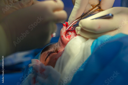 Surgeon and his assistant performing cosmetic surgery on nose in hospital operating room. Nose reshaping, augmentation. Rhinoplasty.