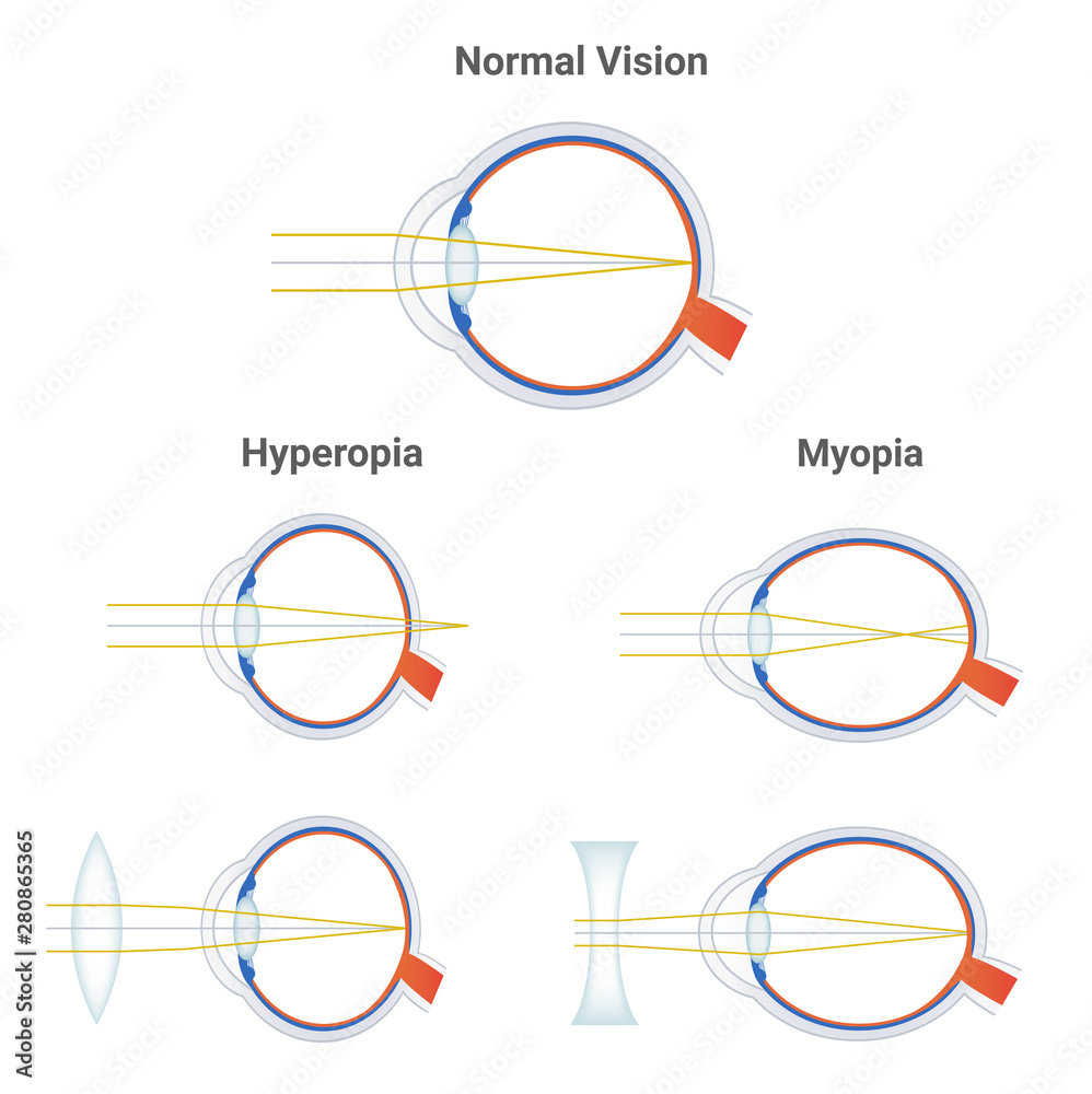 Myopia, hyperopia and normal vision. Common vision disorders. Short sightedness, far sightedness and corrected eye by plus positive lens and minus negative lens. Icons with focusing of light isolated. - obrazy, fototapety, plakaty 