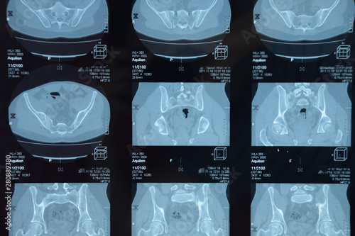 MRI sacroiliac articulation. Study of ankylosing spondyloarthritis patient.
